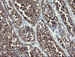 IHC of paraffin-embedded Carcinoma of Human thyroid tissue using anti-SLA2 mouse monoclonal antibody.