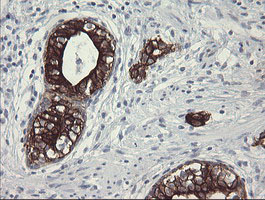 IHC of paraffin-embedded Carcinoma of Human prostate tissue using anti-SLA2 mouse monoclonal antibody.