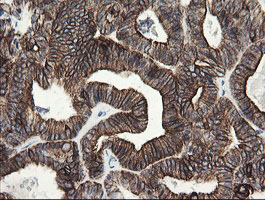 IHC of paraffin-embedded Adenocarcinoma of Human endometrium tissue using anti-SLA2 mouse monoclonal antibody.