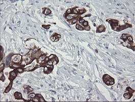 IHC of paraffin-embedded Adenocarcinoma of Human breast tissue using anti-SLA2 mouse monoclonal antibody.