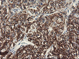 IHC of paraffin-embedded Carcinoma of Human kidney tissue using anti-SLA2 mouse monoclonal antibody.