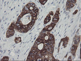 IHC of paraffin-embedded Adenocarcinoma of Human colon tissue using anti-SLA2 mouse monoclonal antibody.