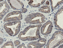 IHC of paraffin-embedded Carcinoma of Human prostate tissue using anti-SLA2 mouse monoclonal antibody.