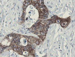 IHC of paraffin-embedded Adenocarcinoma of Human colon tissue using anti-SLA2 mouse monoclonal antibody.