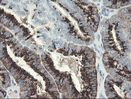IHC of paraffin-embedded Adenocarcinoma of Human endometrium tissue using anti-SLA2 mouse monoclonal antibody.