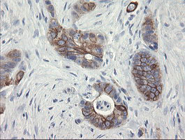IHC of paraffin-embedded Adenocarcinoma of Human colon tissue using anti-SLA2 mouse monoclonal antibody.