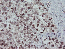 IHC of paraffin-embedded Adenocarcinoma of Human ovary tissue using anti-SLA2 mouse monoclonal antibody. (Heat-induced epitope retrieval by 10mM citric buffer, pH6.0, 100C for 10min).