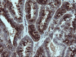 IHC of paraffin-embedded Adenocarcinoma of Human endometrium tissue using anti-SLA2 mouse monoclonal antibody. (Heat-induced epitope retrieval by 10mM citric buffer, pH6.0, 100C for 10min).
