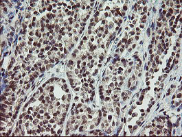 IHC of paraffin-embedded Carcinoma of Human thyroid tissue using anti-SLA2 mouse monoclonal antibody. (Heat-induced epitope retrieval by 10mM citric buffer, pH6.0, 100C for 10min).