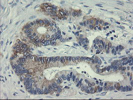 IHC of paraffin-embedded Adenocarcinoma of Human colon tissue using anti-SLA2 mouse monoclonal antibody.