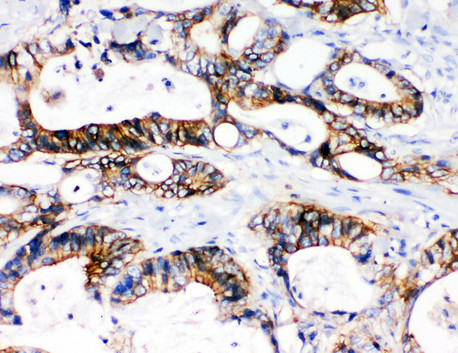 SLC12A2 / NKCC1 antibody. IHC(P): Human Intestinal Cancer Tissue.