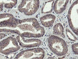 IHC of paraffin-embedded Carcinoma of Human prostate tissue using anti-PROSC mouse monoclonal antibody. (Heat-induced epitope retrieval by 10mM citric buffer, pH6.0, 100C for 10min).