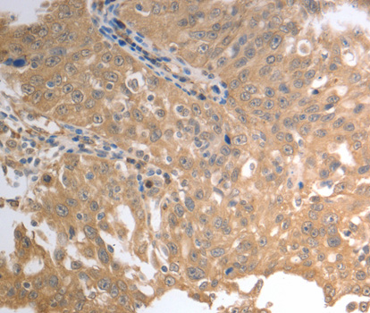 Immunohistochemistry of paraffin-embedded human ovarian cancer tissue, using SLC1A4 antibody.