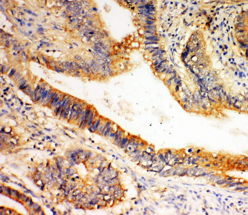 SLC1A4 / ASCT1 antibody. IHC(P): Human Intestinal Cancer Tissue.