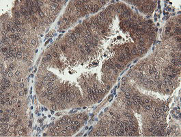 IHC of paraffin-embedded Adenocarcinoma of Human endometrium tissue using anti-PROSC mouse monoclonal antibody. (Heat-induced epitope retrieval by 10mM citric buffer, pH6.0, 100C for 10min).