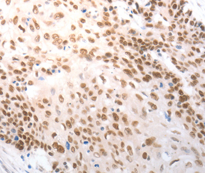 Immunohistochemistry of paraffin-embedded human breast cancer tissue using SLC22A8 antibody.