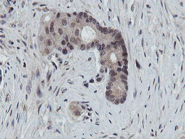IHC of paraffin-embedded Adenocarcinoma of Human colon tissue using anti-PROSC mouse monoclonal antibody. (Heat-induced epitope retrieval by 10mM citric buffer, pH6.0, 100C for 10min).