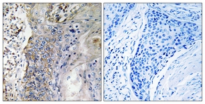 IHC of paraffin-embedded human lung carcinoma tissue, using SLC28A2 Antibody. The picture on the right is treated with the synthesized peptide.