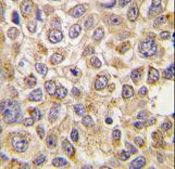 Formalin-fixed and paraffin-embedded human breast carcinoma tissue reacted with PMAT(Slc29a4) Antibody , which was peroxidase-conjugated to the secondary antibody, followed by DAB staining. This data demonstrates the use of this antibody for immunohistochemistry; clinical relevance has not been evaluated.