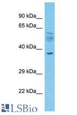 SLC2A4RG / GEF antibody Western Blot of Esophagus Tumor. Antibody dilution: 1 ug/ml.