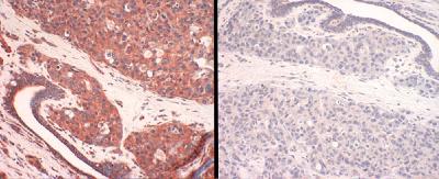 Panel 1: human CTR1 staining of breast cancer tissue. Panel 2: human CTR1-antigen competition in breast cancer tissue.