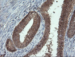 IHC of paraffin-embedded Adenocarcinoma of Human endometrium tissue using anti-PROSC mouse monoclonal antibody.