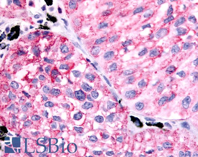 Anti-PTGER1 / EP1 antibody IHC of human Lung, Non-Small Cell Carcinoma. Immunohistochemistry of formalin-fixed, paraffin-embedded tissue after heat-induced antigen retrieval.