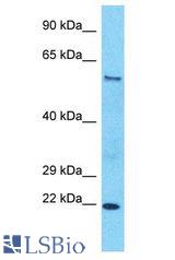 SLC43A2 antibody Western Blot of Esophagus Tumor. Antibody dilution: 1 ug/ml.