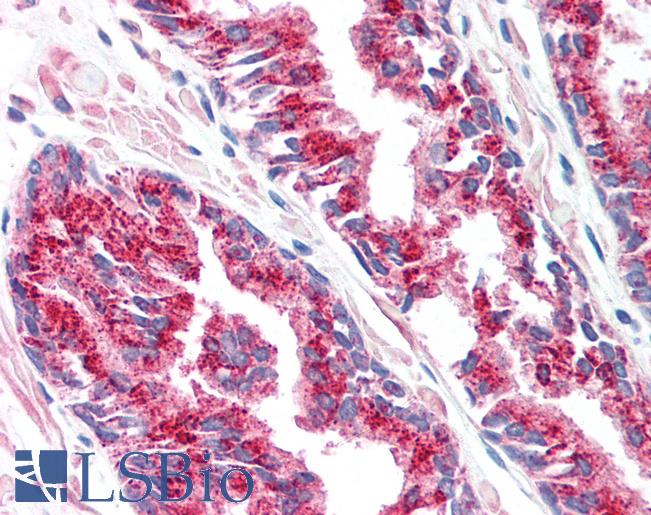 Anti-SLC45A3 / Prostein antibody IHC of human prostate. Immunohistochemistry of formalin-fixed, paraffin-embedded tissue after heat-induced antigen retrieval. Antibody LS-B1623 concentration 5 ug/ml.