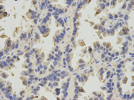 Immunohistochemistry of paraffin-embedded human lung cancer using SLC4A4 antibody at dilution of 1:200 (400x lens).