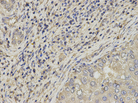 Immunohistochemistry of paraffin-embedded human liver cancer using SLC4A4 antibody at dilution of 1:200 (400x lens).