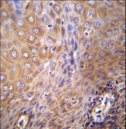 SLC6A14 Antibody immunohistochemistry of formalin-fixed and paraffin-embedded human esophageal carcinoma followed by peroxidase-conjugated secondary antibody and DAB staining.