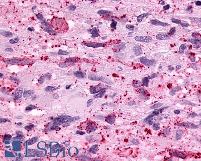 Anti-PTGER3 / EP3 antibody IHC of human brain, glioblastoma. Immunohistochemistry of formalin-fixed, paraffin-embedded tissue after heat-induced antigen retrieval.