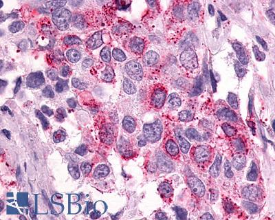 Anti-PTGER3 / EP3 antibody IHC of human Breast, Carcinoma. Immunohistochemistry of formalin-fixed, paraffin-embedded tissue after heat-induced antigen retrieval.