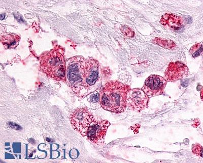 Anti-PTGER3 / EP3 antibody IHC of human Pancreas, Carcinoma. Immunohistochemistry of formalin-fixed, paraffin-embedded tissue after heat-induced antigen retrieval.