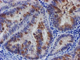 IHC of paraffin-embedded Adenocarcinoma of Human endometrium tissue using anti-SLFNL1 mouse monoclonal antibody.