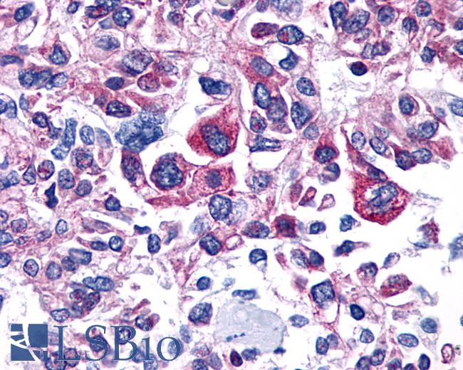 Anti-PTGER4 / EP4 antibody IHC of human Prostate, Carcinoma. Immunohistochemistry of formalin-fixed, paraffin-embedded tissue after heat-induced antigen retrieval.