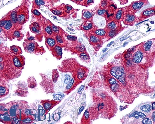 Anti-PTGER4 / EP4 antibody IHC of human Lung, Adenocarcinoma. Immunohistochemistry of formalin-fixed, paraffin-embedded tissue after heat-induced antigen retrieval.