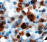 IHC of ALK-1 on FFPE Anaplastic Large Cell Lymphoma tissue.