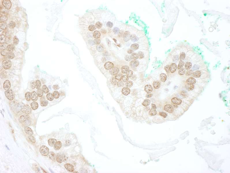 Detection of Human BTBD12 by Immunohistochemistry. Sample: FFPE section of human prostate carcinoma. Antibody: Affinity purified rabbit anti-BTBD12 used at a dilution of 1:250.
