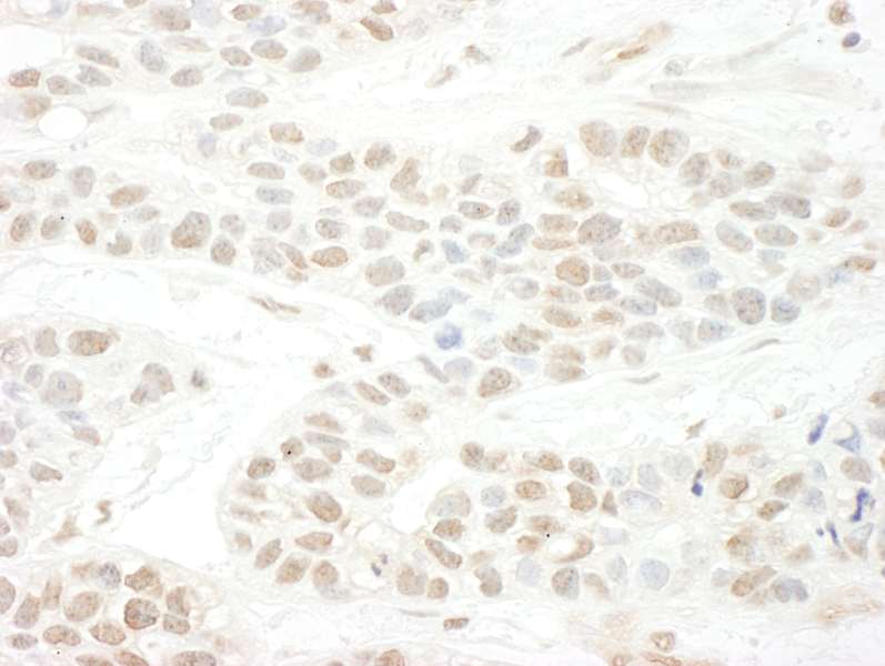 Detection of Human BTBD12 by Immunohistochemistry. Sample: FFPE section of human breast carcinoma. Antibody: Affinity purified rabbit anti-BTBD12 used at a dilution of 1:1000 (1 ug/ml).