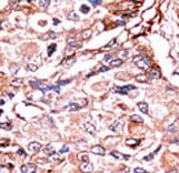 Formalin-fixed and paraffin-embedded human cancer tissue reacted with the primary antibody, which was peroxidase-conjugated to the secondary antibody, followed by AEC staining. This data demonstrates the use of this antibody for immunohistochemistry; clinical relevance has not been evaluated. BC = breast carcinoma; HC = hepatocarcinoma.
