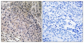 IHC of paraffin-embedded human breast carcinoma tissue, using TEBP (Ab-113) Antibody. The picture on the right is treated with the synthesized peptide.
