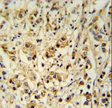 SMAGP Antibody immunohistochemistry of formalin-fixed and paraffin-embedded human breast carcinoma followed by peroxidase-conjugated secondary antibody and DAB staining.