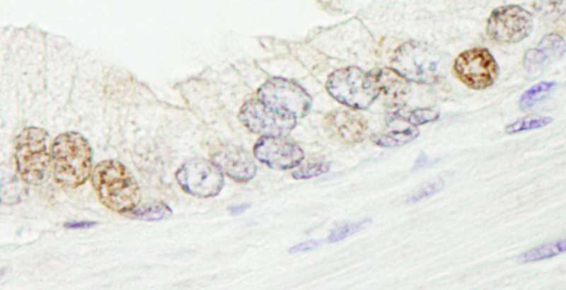 Detection of Human SMARCA1/SNF2L by Immunohistochemistry. Sample: FFPE section of human prostate carcinoma. Antibody: Affinity purified rabbit anti-SMARCA1/SNF2L used at a dilution of 1:5000 (0.2 ug/ml). Detection: DAB.