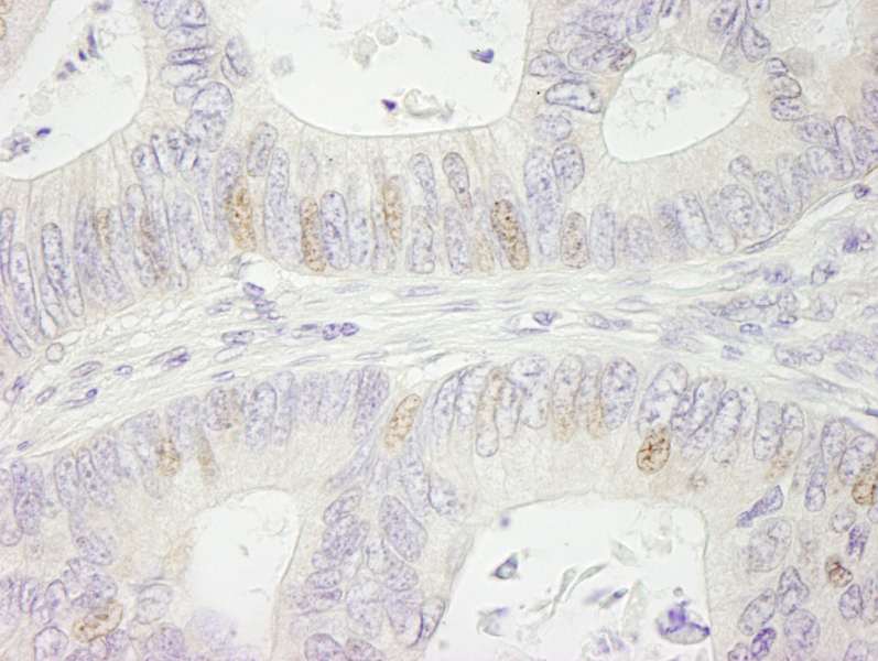 Detection of Human SMARCA1/SNF2L by Immunohistochemistry. Sample: FFPE section of human colon carcinoma. Antibody: Affinity purified rabbit anti-SMARCA1/SNF2L used at a dilution of 1:500.