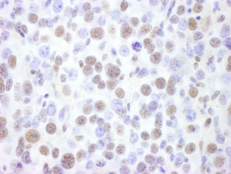 Detection of Mouse BRG1 by Immunohistochemistry. Sample: FFPE section of mouse renal cell carcinoma. Antibody: Affinity purified rabbit anti-BRG1 used at a dilution of 1:1000 (1 ug/ml). Detection: DAB.
