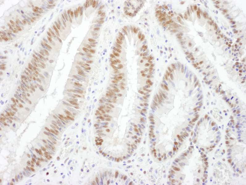 Detection of Human BRG1 by Immunohistochemistry. Sample: FFPE section of human colon carcinoma. Antibody: Affinity purified rabbit anti-BRG1 used at a dilution of 1:1000 (1 ug/ml). Detection: DAB.