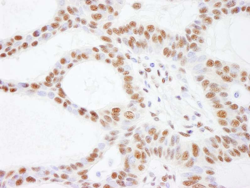 Detection of Human SMARCC2/BAF170 by Immunohistochemistry. Sample: FFPE section of human skin basal cell carcinoma. Antibody: Affinity purified rabbit anti-SMARCC2/BAF170 used at a dilution of 1:200 (1 ug/ml). Detection: DAB.