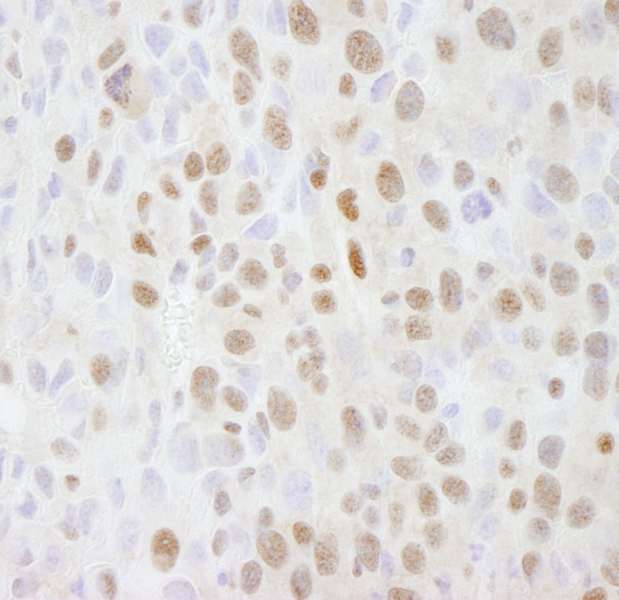 Detection of Mouse SMARCC2/BAF170 by Immunohistochemistry. Sample: FFPE section of mouse squamous cell carcinoma. Antibody: Affinity purified rabbit anti-SMARCC2/BAF170 used at a dilution of 1:500.